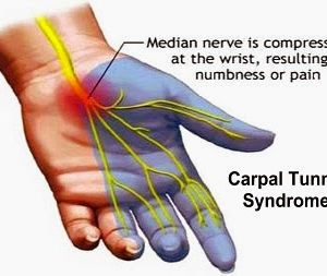 Identify, Treat, and Prevent Carpal Tunnel Syndrome Week 30