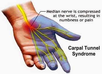 Identify, Treat, and Prevent Carpal Tunnel Syndrome Week 30